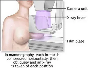 mamografija-proced