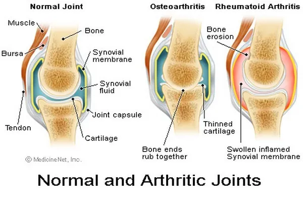 Osteoarthritis-of-Knee_clip_image001