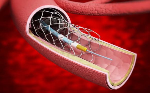 Dr Šulc: Imam stent u arteriji, da li je bezbedno da uradim detoksifikaciju?